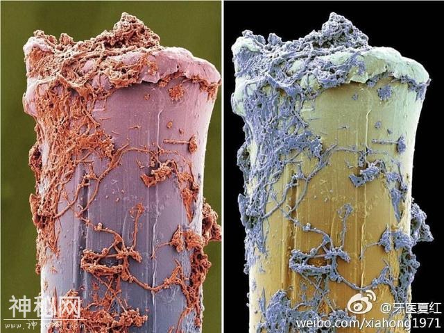 牙齿上的细菌-2.jpg