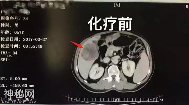 从癌症晚期到肿瘤消失 医生感叹：从医以来见的头一例！-4.jpg