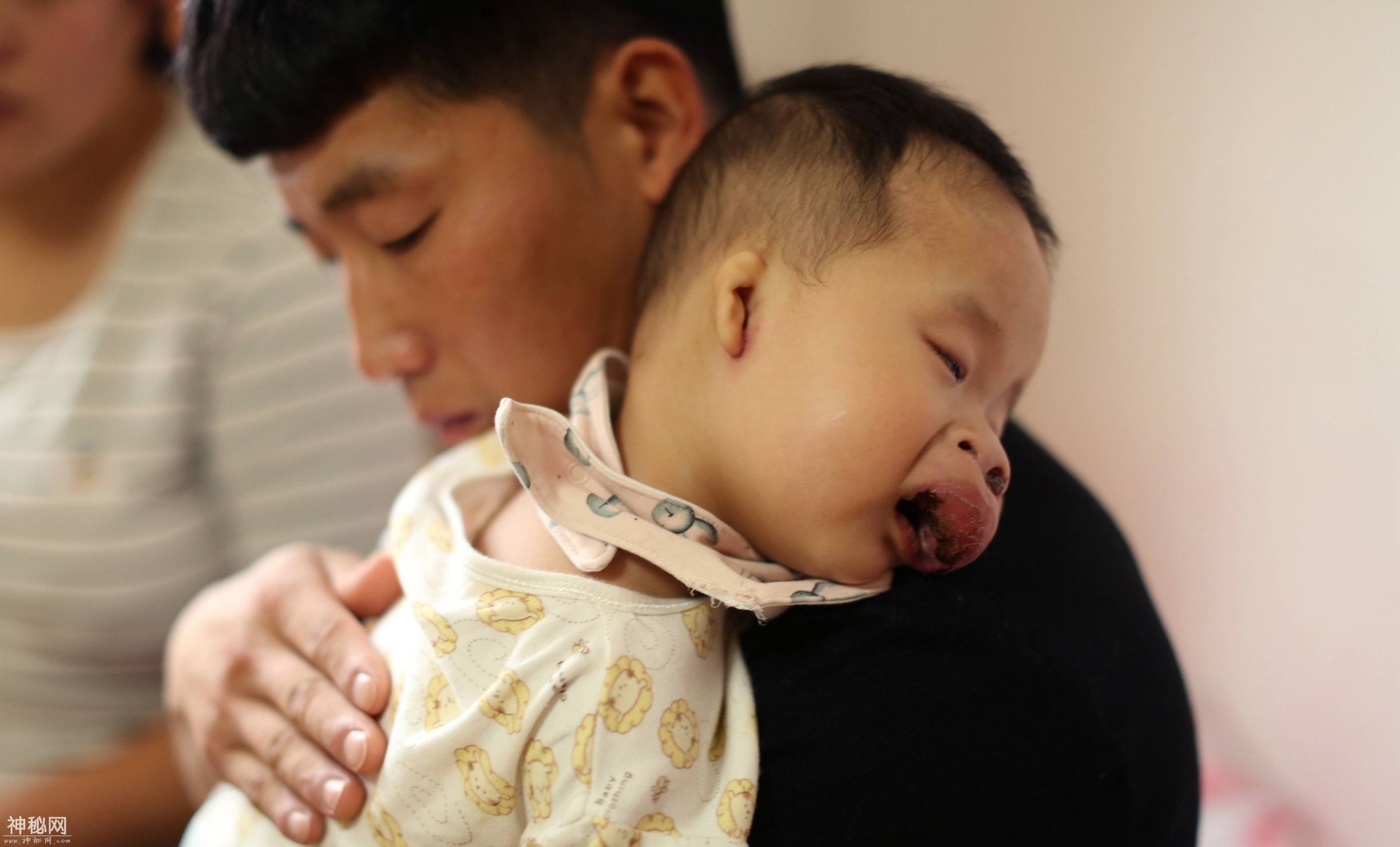 一岁孩子得怪病长成猪鼻子，急坏家人，被外人嘲笑是八戒-6.jpg