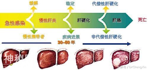 乙肝-肝硬化-肝癌三部曲真的存在吗？-1.jpg