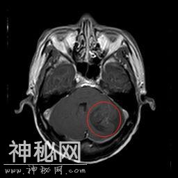 怪病！男子脑袋和下肢惊现囊虫，竟然是因为吃了这个-1.jpg