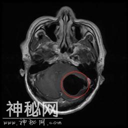 怪病！男子脑袋和下肢惊现囊虫，竟然是因为吃了这个-2.jpg