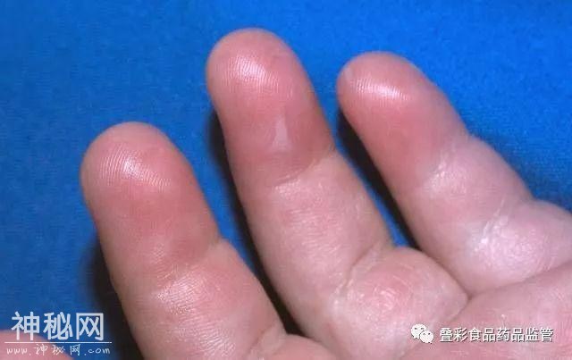 官方提醒！桂林这种病毒进入高发期，传染性极强，这类人要尤其当心！-3.jpg