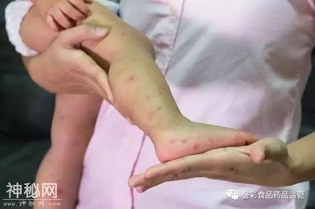 官方提醒！桂林这种病毒进入高发期，传染性极强，这类人要尤其当心！-6.jpg