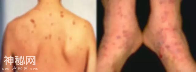 为了对抗这种感染3亿人的病毒，他们靠人体实验堆出了这种疫苗-3.jpg