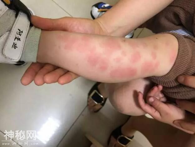 杭州好多孩子被“怪病”折磨！腿上一片通红 通宵不睡觉-2.jpg