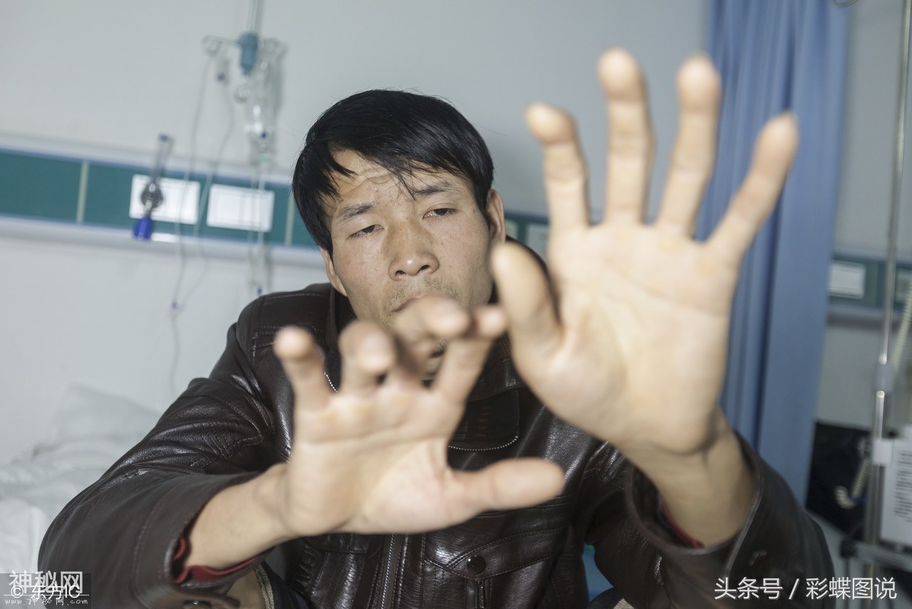 29岁男子得怪病逆生长，个子越长越高身体越来越轻，眼睛几近失明-4.jpg