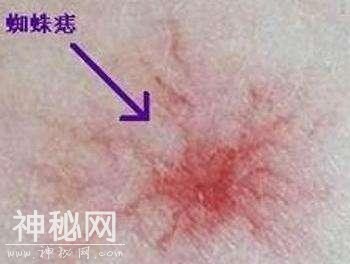 这种“痣”出现，或暗示肝脏病变，不要不以为然-2.jpg