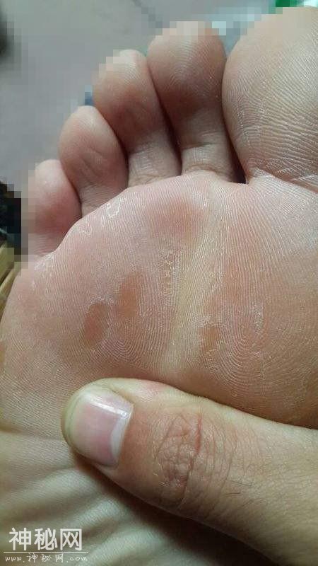 脚上长水泡脱皮，还很痒怎么办？这样用药才是关键，别再吃错药了-1.jpg