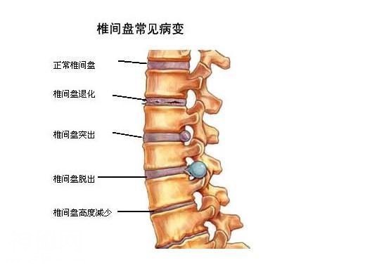 根治腰椎间盘突出绝技-1.jpg