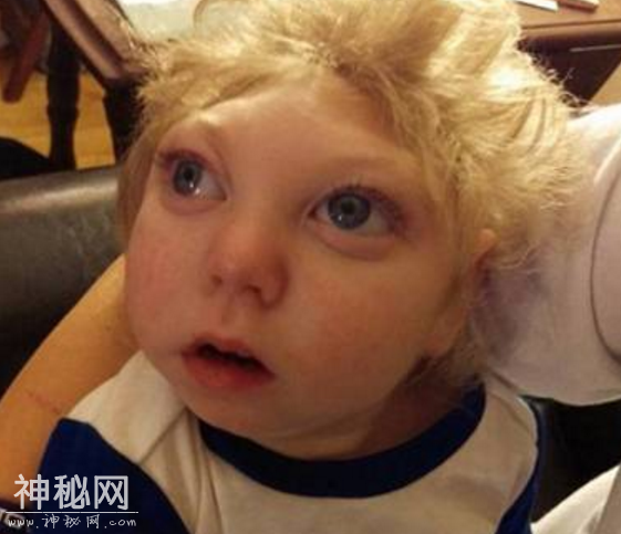 小男孩患“怪病”只有半个脑袋，医生断言活不过3个月，如今3岁-4.jpg