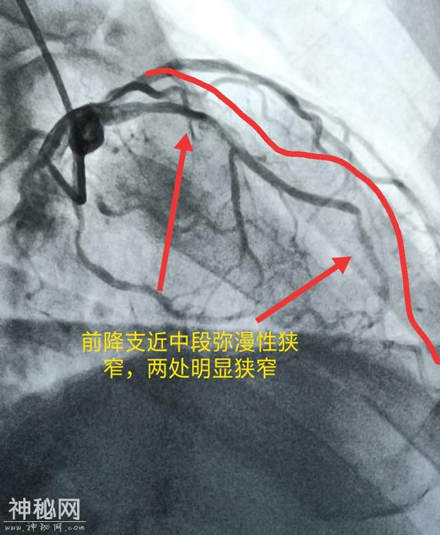 体检发现血液里这个指标正常别沾沾自喜，因为人家分三六九等-4.jpg