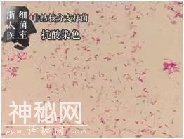 28岁女子打“瘦腿针”后险遭截肢！腿上发现超难缠“神秘细菌”！-6.jpg