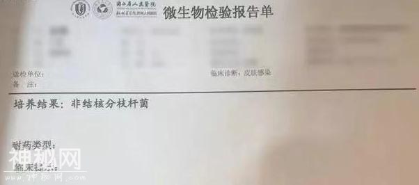 28岁女子打“瘦腿针”后险遭截肢！腿上发现超难缠“神秘细菌”！-4.jpg
