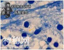 28岁女子打“瘦腿针”后险遭截肢！腿上发现超难缠“神秘细菌”！-5.jpg