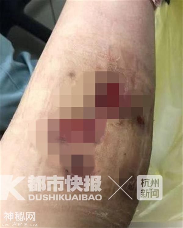 杭州28岁女子打“瘦腿针”后皮肤溃烂险遭截肢，原来是“神秘细菌”惹的祸-2.jpg
