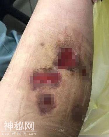 28岁女艺人打“瘦腿针”后险遭截肢！腿上发现“神秘细菌”-3.jpg