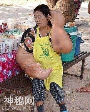 泰国女子患罕见怪病，手臂比大腿还粗，成为“世界上最大的手”！-1.jpg