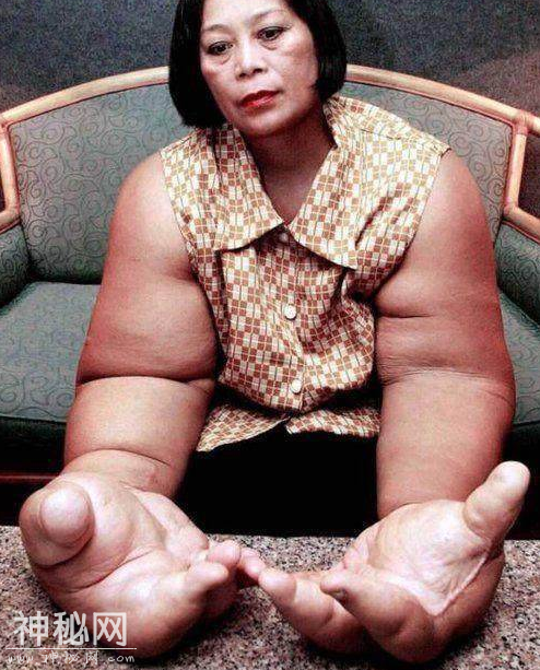 泰国女子患罕见怪病，手臂比大腿还粗，成为“世界上最大的手”！-5.jpg