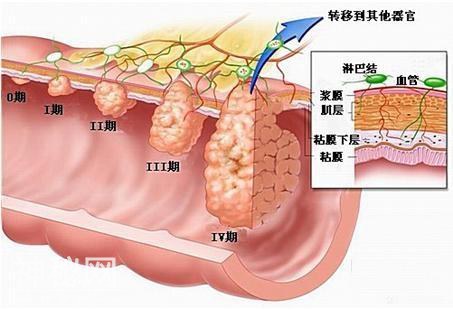 癌症是绝症吗？目前有没有癌症被治愈的例子？医生告诉你答案-4.jpg