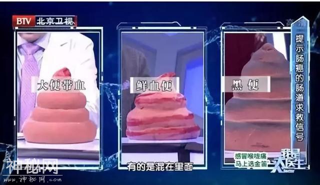 痔疮到底怎么治疗？把握好4个要点！医生提醒：小心伪装者直肠癌-4.jpg