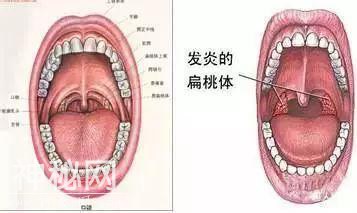 男子咳出自己的扁桃体！惊恐：我是不是得了什么绝症？！-7.jpg