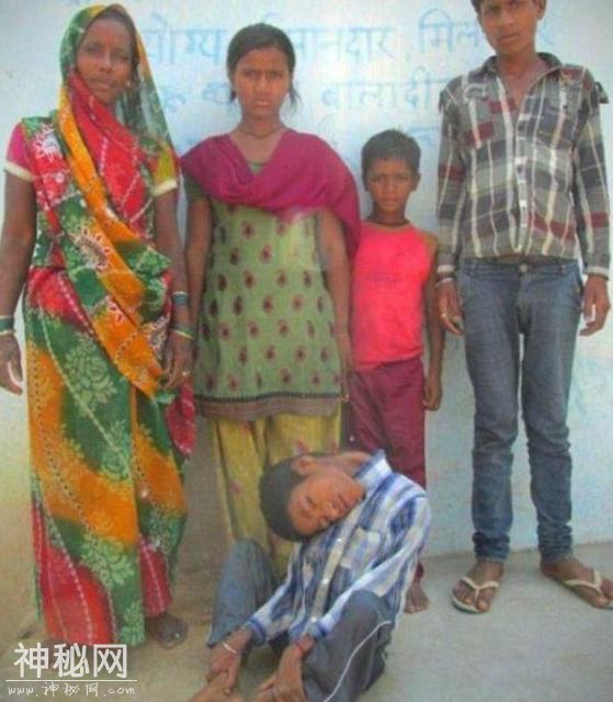 印度14岁男孩患罕见怪病，脖子弯曲180度，最大心愿是能上学-2.jpg