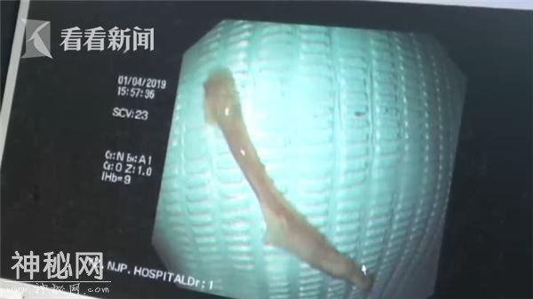 恐怖！大爷喝了碗鸡汤被4厘米鸡骨头横插食管……-2.jpg