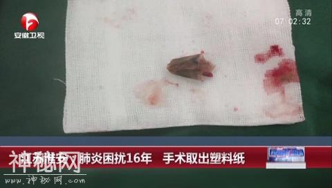 24岁男子反复肺炎十几年，只吊水消炎，检查发现竟是8岁时惹的祸-3.jpg