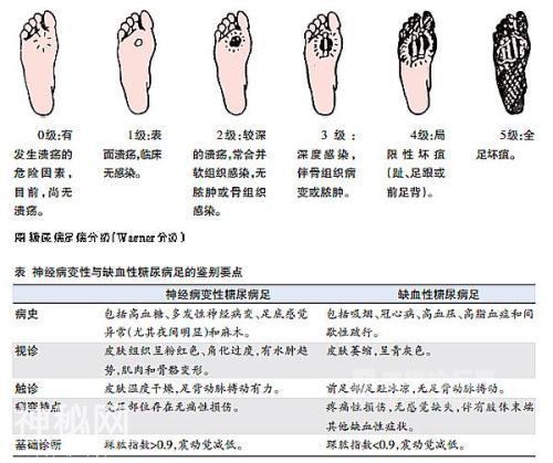 怎么治疗糖尿病足？细菌分析很重要，这种超级细菌要早处理。-3.jpg