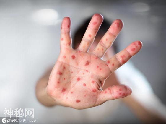 这两种小儿病毒感染疾病即将高发，症状很相似，该如何识别和护理-5.jpg