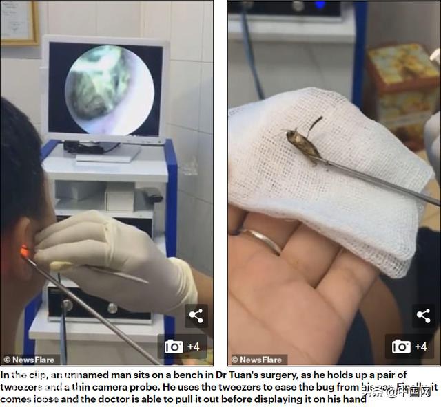 毛骨悚然！男子耳痛三天，医生检查后发现耳朵里竟住了只蝴蝶-3.jpg
