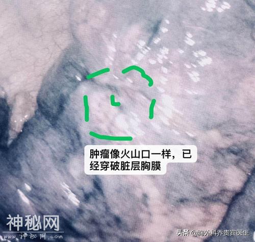 发现肺结节接近胸膜的一定要警惕！突然脏层就易广泛转移-2.jpg