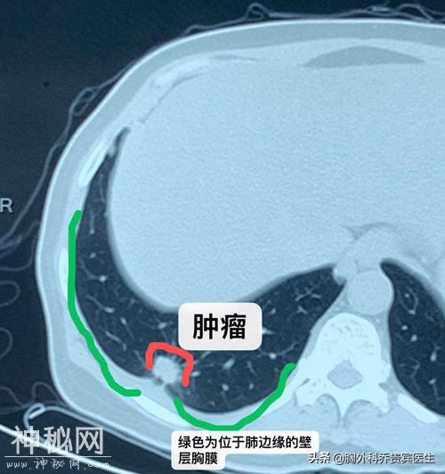 发现肺结节接近胸膜的一定要警惕！突然脏层就易广泛转移-1.jpg