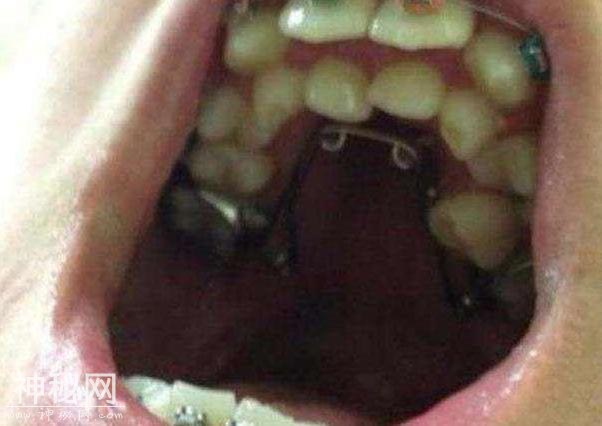 6岁男童张口似“怪兽”，这个“怪病”可吓坏了妈妈-5.jpg