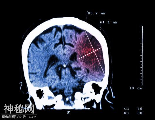 无论男女，身体若有“1软2硬”，十有八九脑梗已上身，早查脑CT-1.jpg