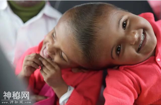 孟加拉国双胞胎女孩患怪病共用头部，经历30小时手术终于重获新生-1.jpg