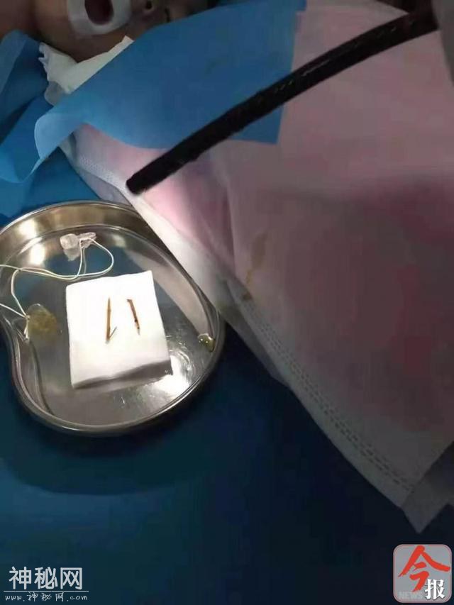 男童得“怪病”反复发烧腹痛，医生进他肚子取出了这东西-2.jpg