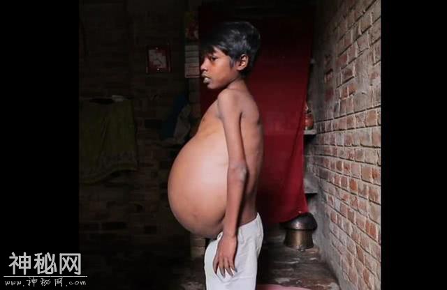 印度男子患上怪病：肚子变得越来越大，身体膨胀如气球-4.jpg