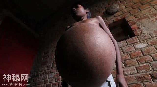 印度男子患上怪病：肚子变得越来越大，身体膨胀如气球-3.jpg