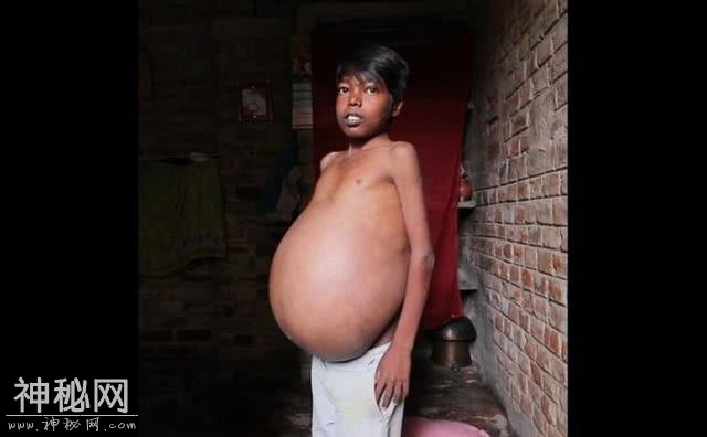 印度男子患上怪病：肚子变得越来越大，身体膨胀如气球-1.jpg