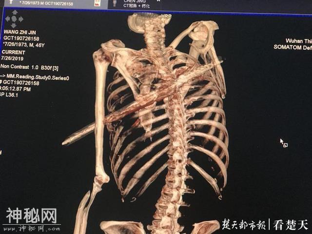 男子脚底打滑意外跌落遭钢筋穿胸，幸好被人发现-1.jpg
