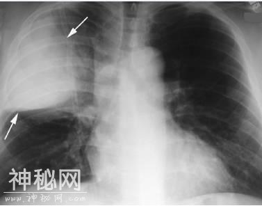 4种肺部细菌感染的影像学特点，这个总结我给满分-1.jpg