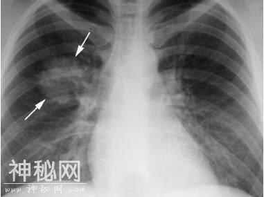 4种肺部细菌感染的影像学特点，这个总结我给满分-2.jpg