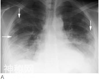 4种肺部细菌感染的影像学特点，这个总结我给满分-4.jpg