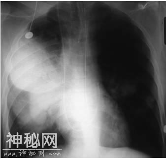 4种肺部细菌感染的影像学特点，这个总结我给满分-5.jpg