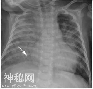 4种肺部细菌感染的影像学特点，这个总结我给满分-3.jpg