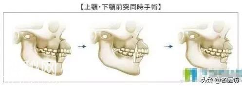 案例丨讲个鬼故事，摘掉牙套的我……没好好戴保持器，又突了-22.jpg