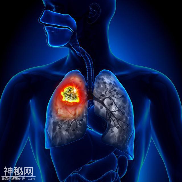 怎么分辨身体得了肺癌，身体又会出现哪些现象呢-3.jpg
