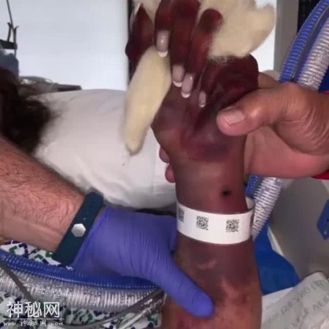 女子因神秘感染被截去双腿双手，医生：狗舔致细菌传播-3.jpg